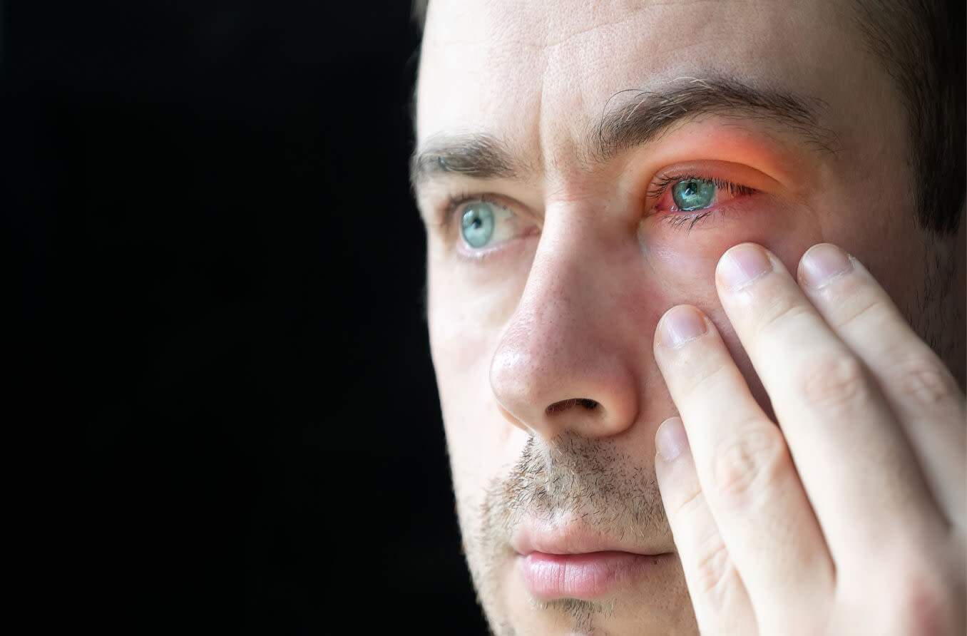 Red eyes and irritation can occur after a bug bite.